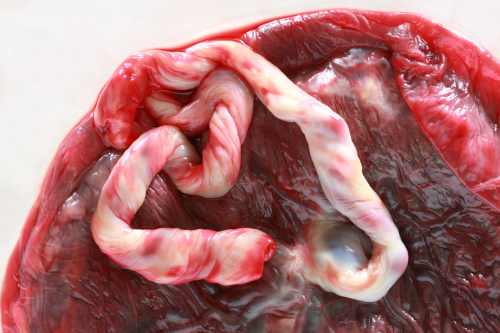 Este é o aspeto anatómico da placenta após o nascimento. Fonte da fotografia: Getty Images Este é o aspeto da placenta após o nascimento, foto anatómica